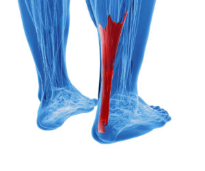 shockwave therapy for achilles tendonitis downtown toronto