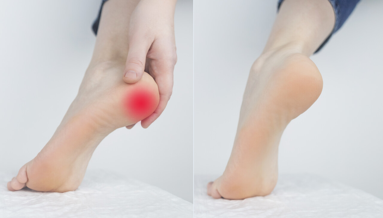 plantar fasciitis chiropody